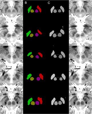 Deep Learning-Based Deep Brain Stimulation Targeting and Clinical Applications